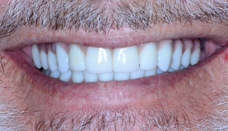 toronto resistente e riparabile zirconia denti zirconio