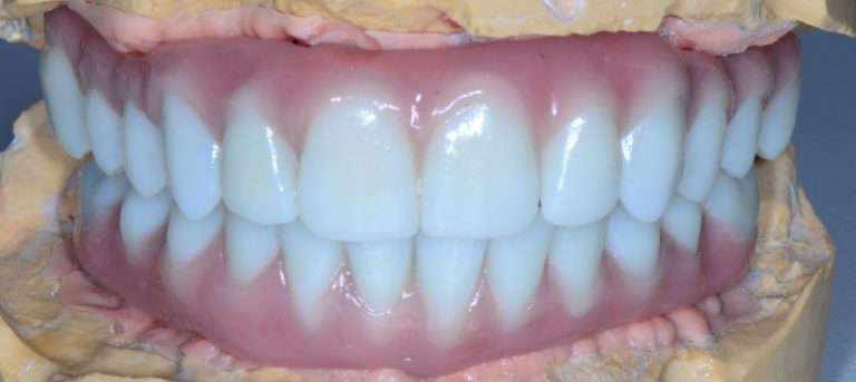 Riabilitazione toronto in zirconia zirconio